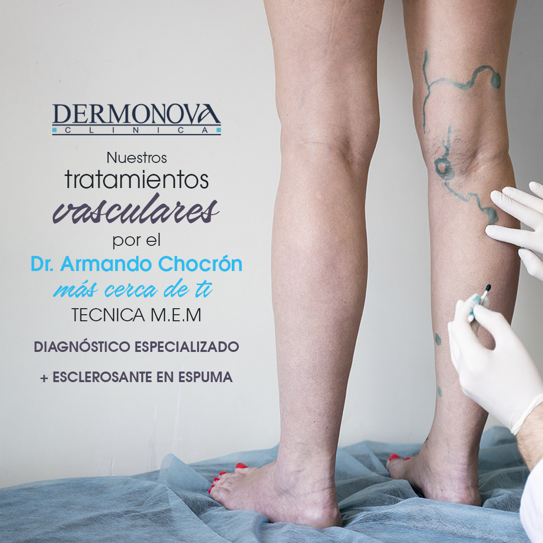 varices Málaga