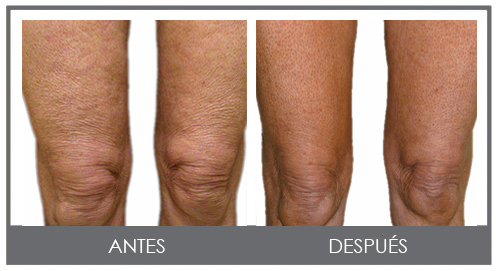 rodilla rejuvenecida