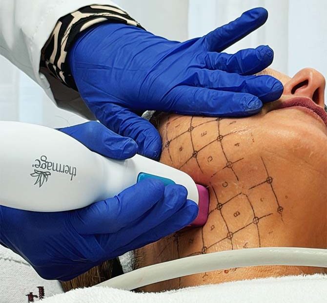 radiofrecuencia monopolar Reaffirmage en Málaga