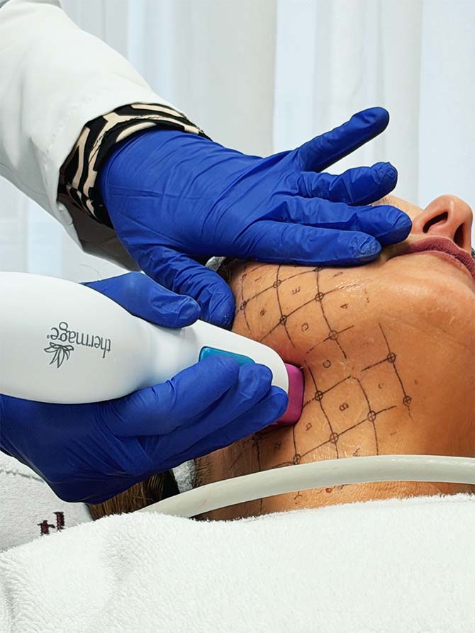 radiofrecuencia monopolar Reaffirmage en Málaga