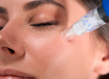 Microneedling