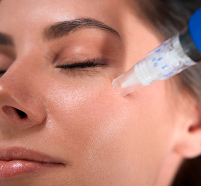 microneedling Málaga