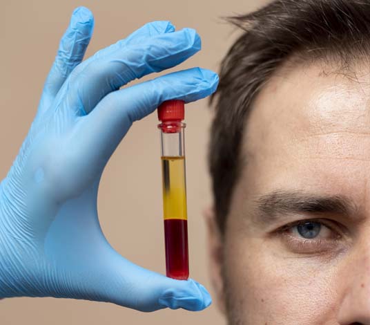 contra la caida capilar en Málaga Bioestimulación Avanzada